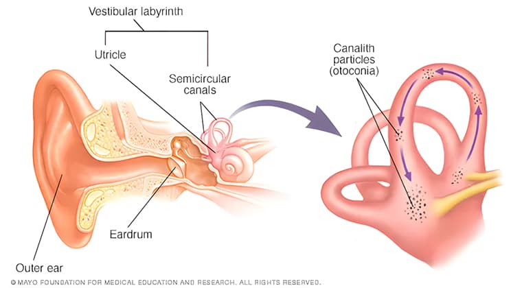 Fondo de Vértigo Posicional Paroxístico Benigno